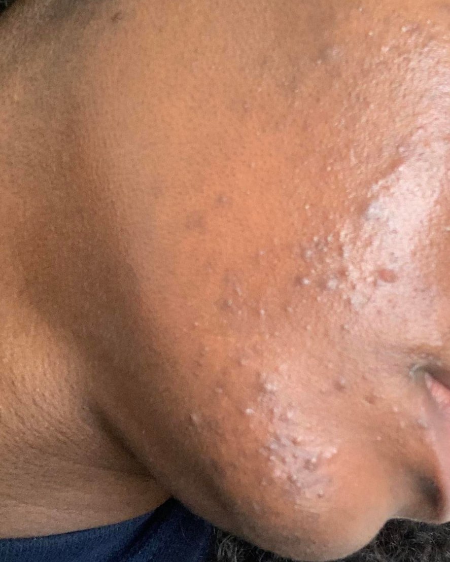 Joue et mâchoire d'une peau foncée avec des boutons et des marques laissées par l'acné