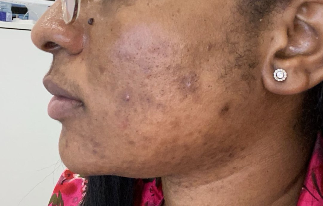 Profil gauche de Johanne avant : boutons, marques brunes et peau inflammée sur la joue et la mâchoire